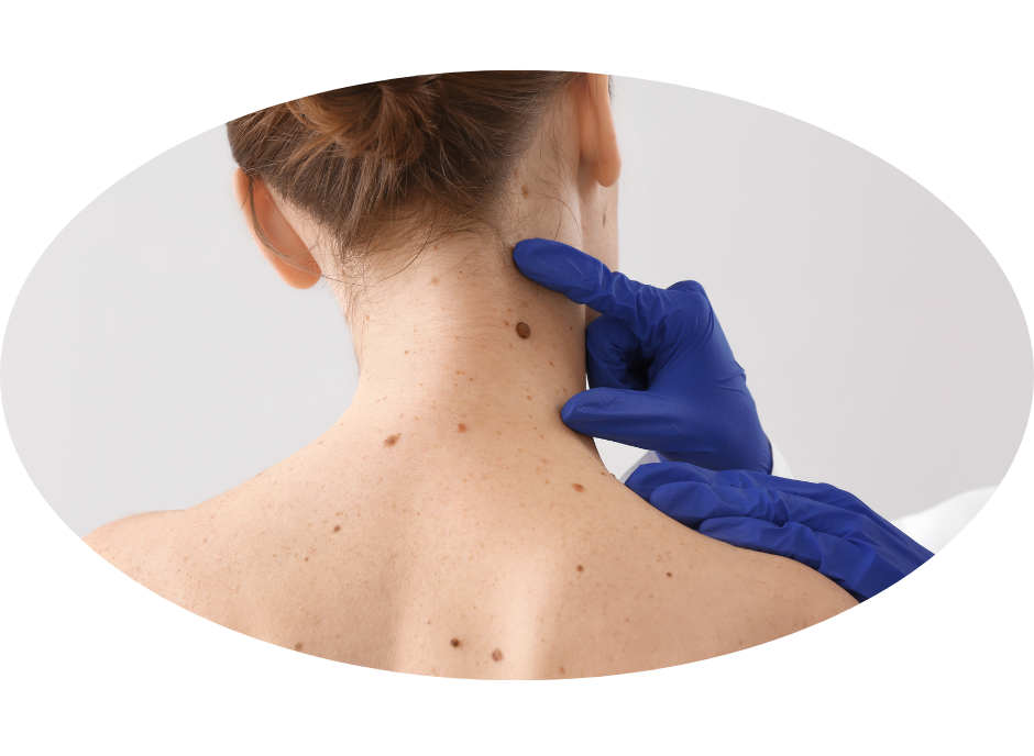 Sun Awareness Week 2025: Are you skin cancer aware?