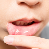 Oral Thrush