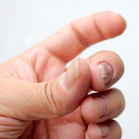 Paronychia (Infected Finger)