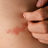 Shingles