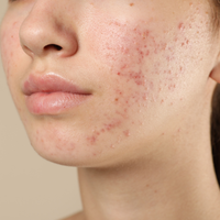 Acne