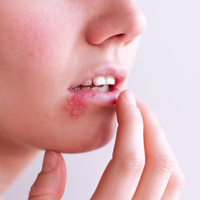 Cold Sores