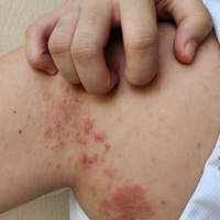 Impetigo